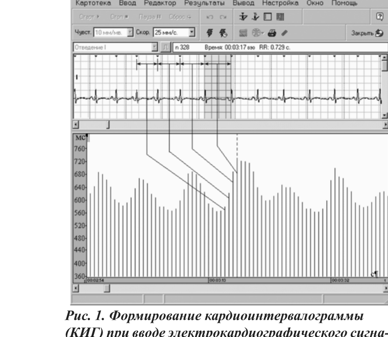 Рис. 1. Формирование кардиоинтервалограммы (КИГ) при вводе электрокардиографического сигнала